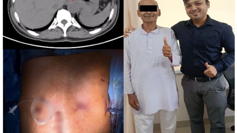 মিশন হাসপাতালে স্বাস্থ্যসাথী কার্ডে নজিরবিহীন ক্যান্সার অপারেশন